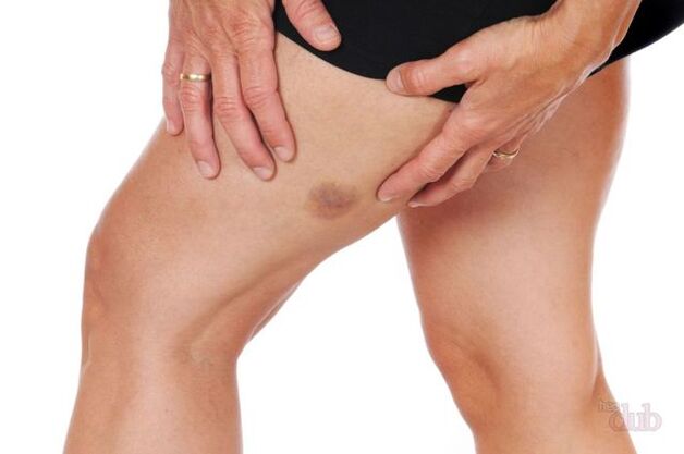 wann eng Vene platzt