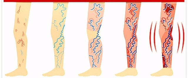 wat net mat Krampfadern ze maachen