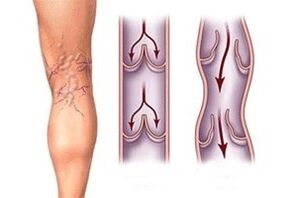 Ausfluss vum Blutt an Krampfadern a verschiddene Stadien vun der Krankheet Entwécklung